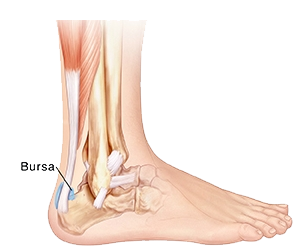 fluid in heel of foot