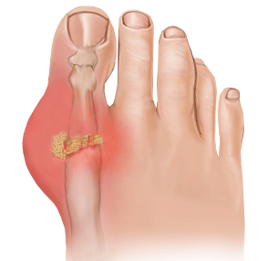 How To Treat Gout Of The Big Toe - The Orthopaedic Foot & Ankle Center