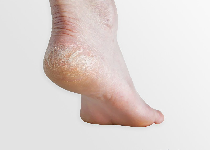 Cracked Heel Causes - Foot Care Products - FootDocStore